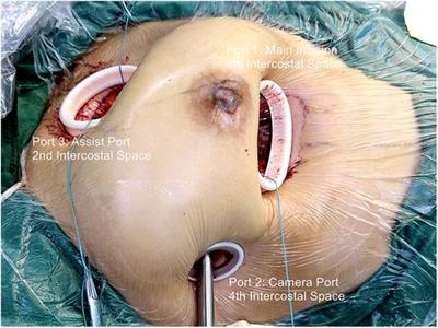 Initial experience and favorable outcomes on cannulation strategies and surgical platform construction in fully video-assisted thoracoscopic cardiac surgery